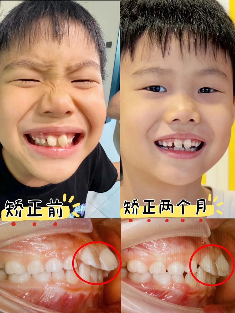 正畸扩弓有什么危害-图3 正畸扩弓有什么危害-图3