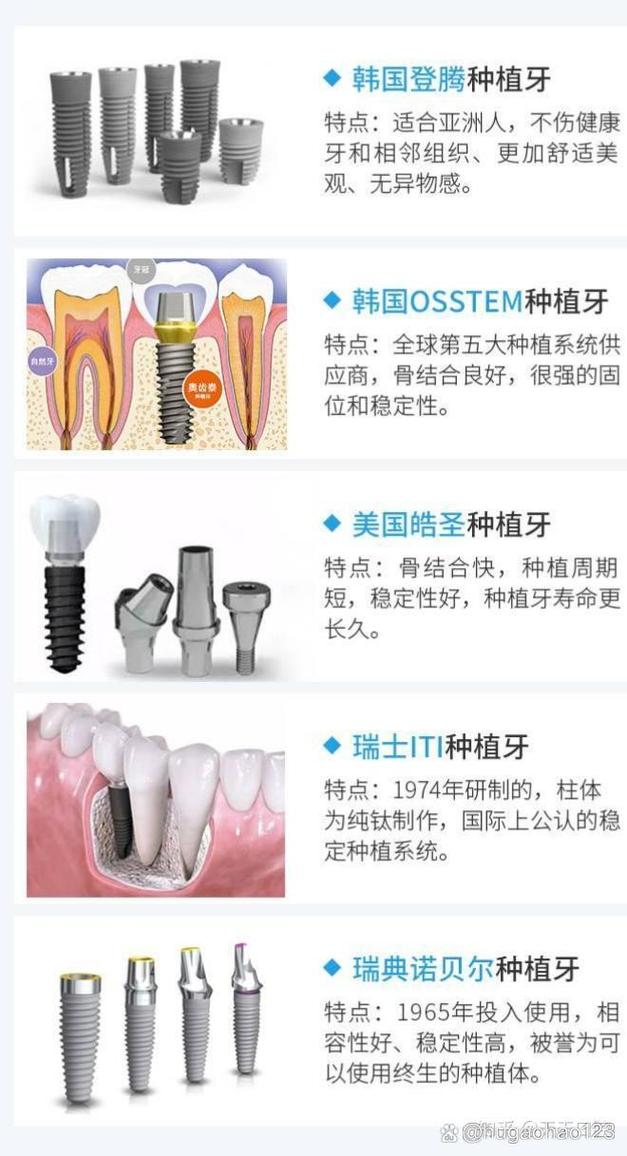 种牙选韩国还是德国？技术、价格、效果怎么比？-图1