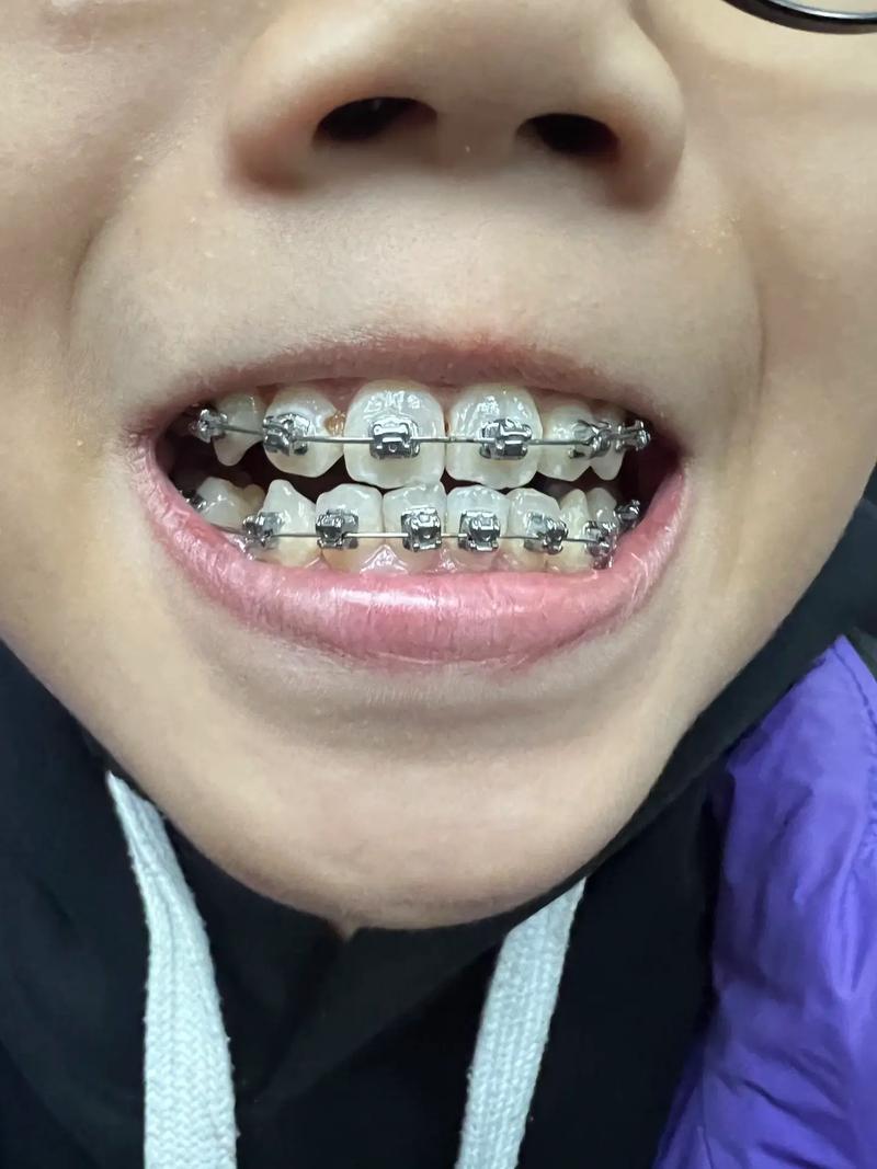 正畸牙每次复诊都痛，是正常现象还是需调整方案？-图2