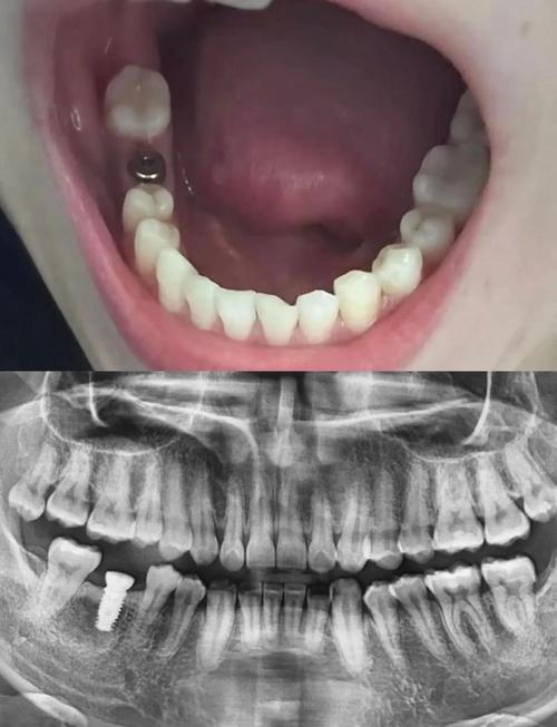 骨密度低 种牙-图1