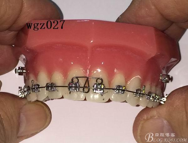 正畸直丝弓托槽是什么？矫正牙齿效果如何？-图1