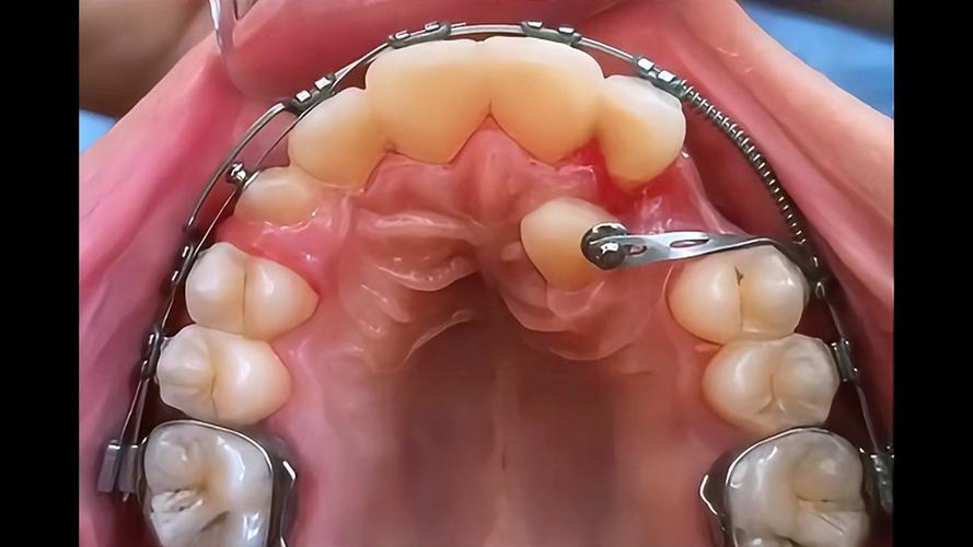正畸牵引倒置埋伏牙-图1 正畸牵引倒置埋伏牙-图1