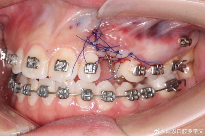 正畸牵引倒置埋伏牙-图3 正畸牵引倒置埋伏牙-图3