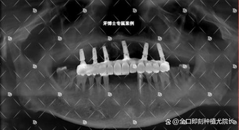 种牙拆线疼正常吗？疼多久能缓解？-图1