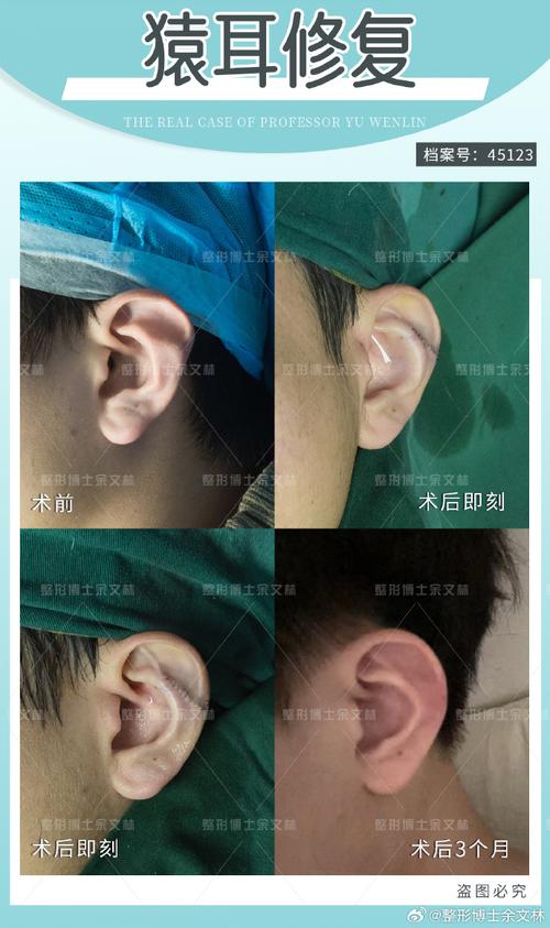 中年人耳朵畸形正畸可行吗？效果如何？-图3