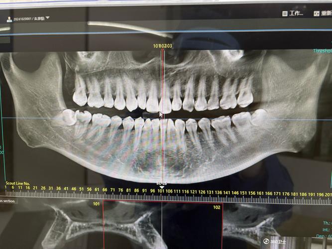 正畸拍X光有辐射吗？安全吗？-图1