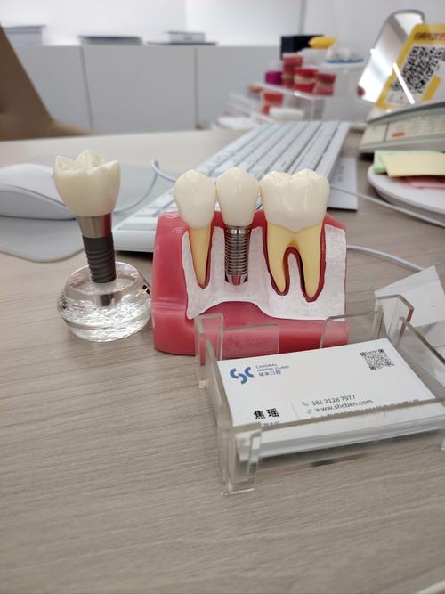 种牙牙冠材料怎么选？哪种更耐用又美观划算？-图1