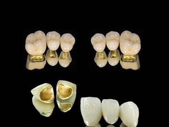 种牙牙冠材料怎么选？哪种更耐用又美观划算？-图2