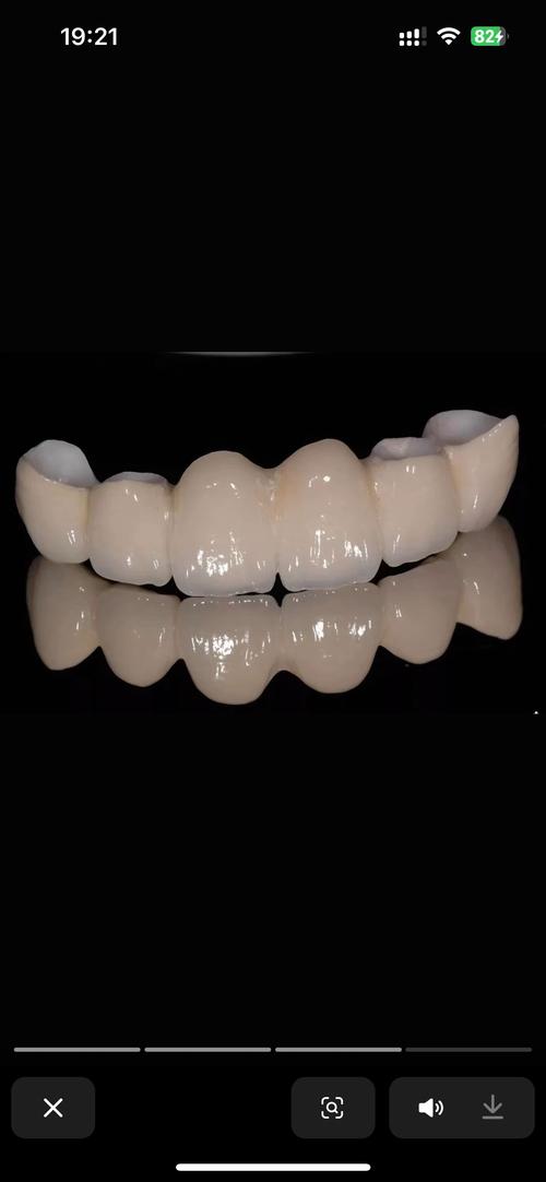 种牙牙冠材料怎么选？哪种更耐用又美观划算？-图3