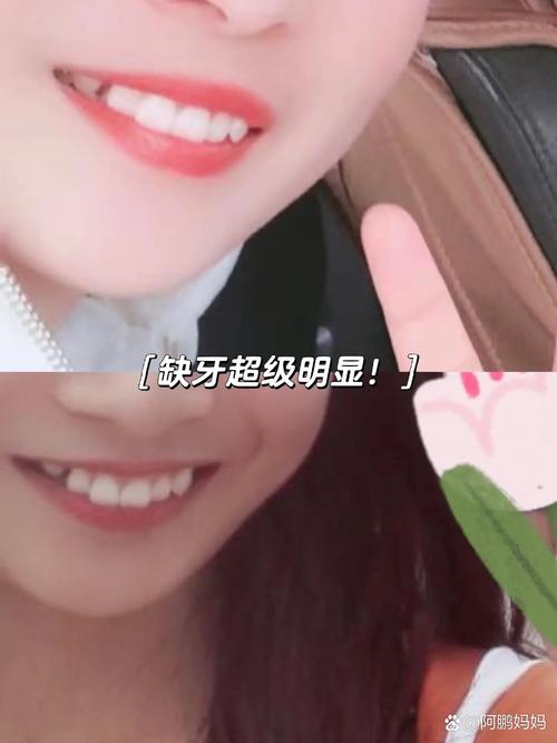 拔正畸牙虎牙开始疼-图2