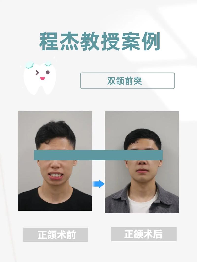 偏颌是正畸还是手术-图1
