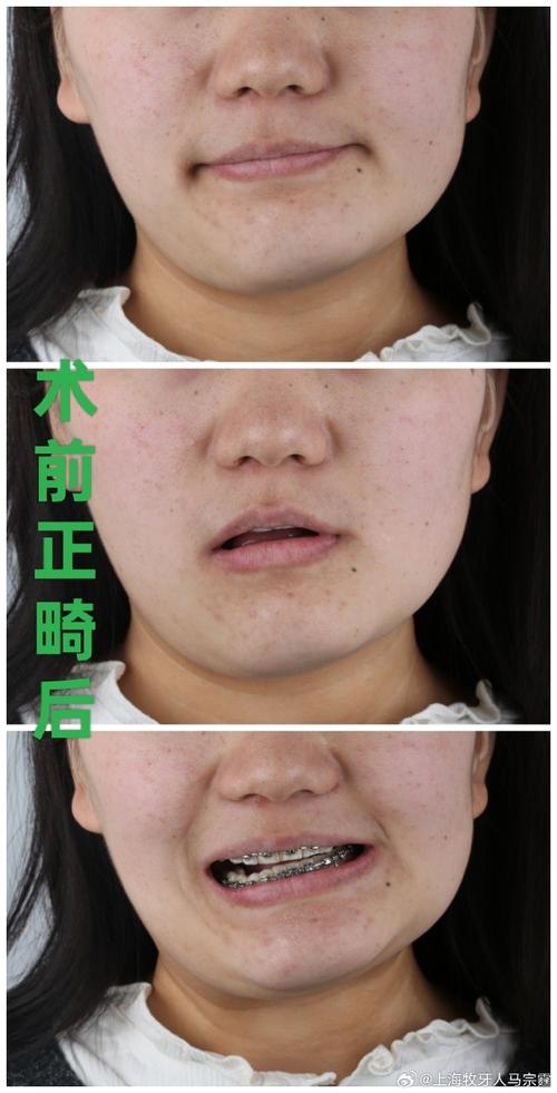 偏颌是正畸还是手术-图2