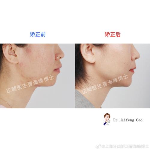 偏颌是正畸还是手术-图3