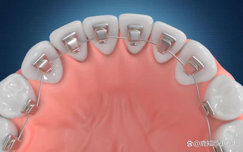 2025种植牙价格会降吗?技术有哪些新突破?-图3 2025种植牙价格会降吗?技术有哪些新突破?-图3
