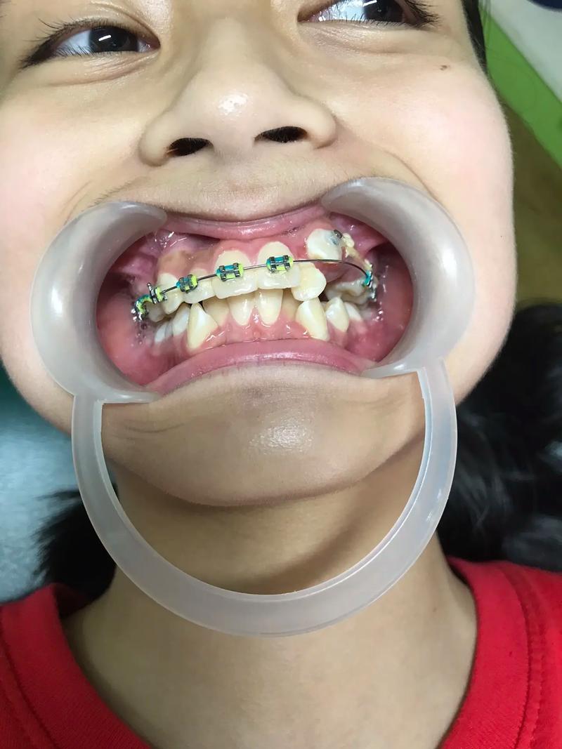 牙齿矫正vs种牙，到底该选哪个？不同情况怎么选？-图3