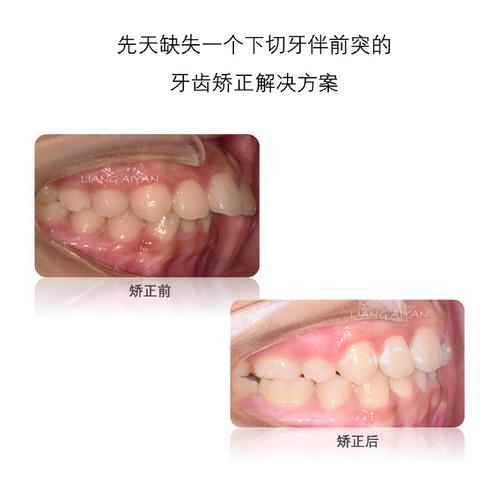 牙根歪了能做正畸吗-图3