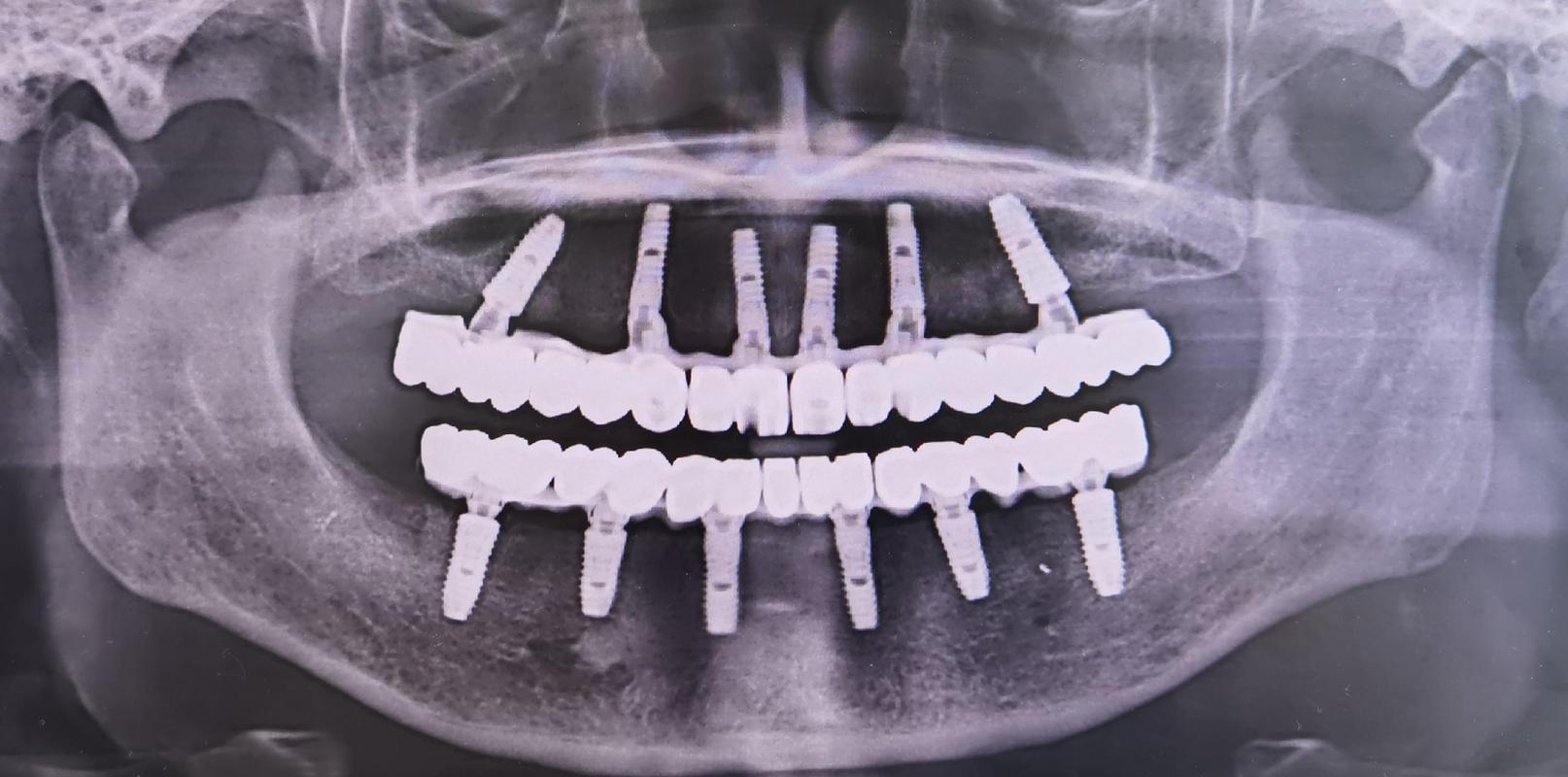 江苏口腔种牙多少钱？正规医院怎么选？-图1