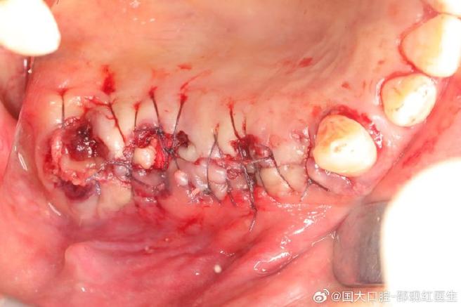 种牙植骨后出血正常吗？需警惕哪些原因及处理方法？-图3