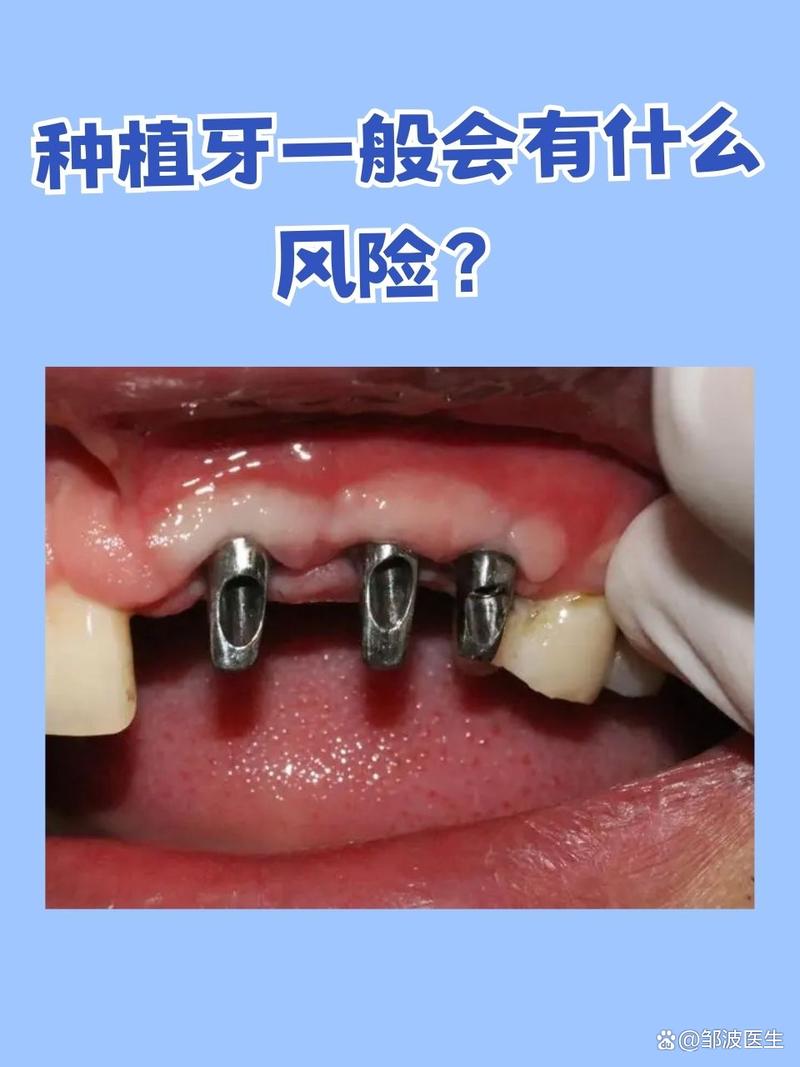 种牙效果怎么样-图3