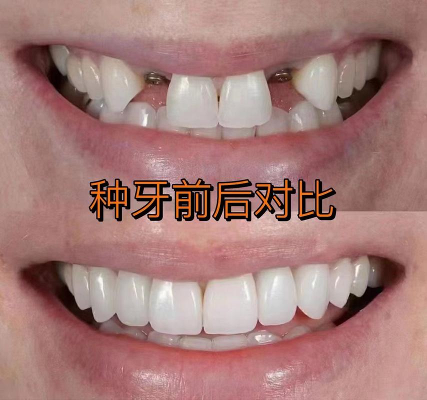 种牙效果怎么样-图2