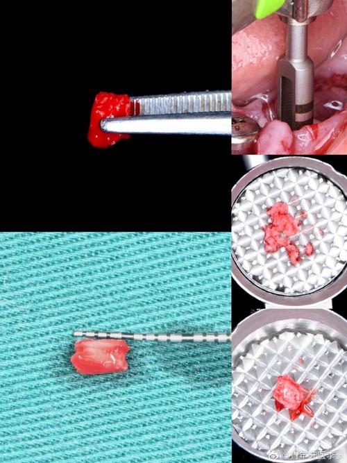 微创种牙危险吗-图2