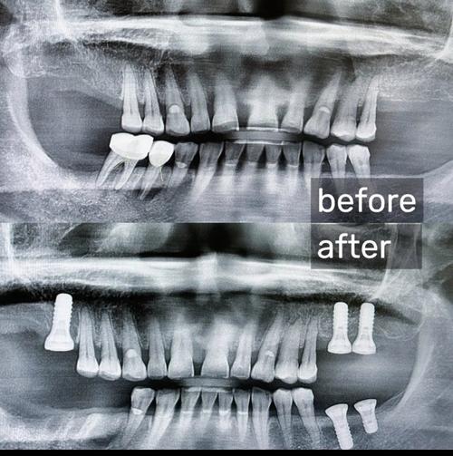 西安哪里种牙好-图2