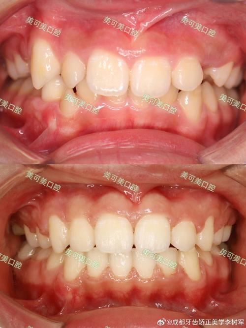 正畸后期咬合变深了-图3