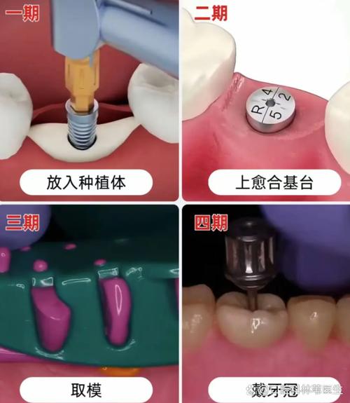 拔牙后立即种牙可行吗?即刻修复效果与风险如何?-图2 拔牙后立即种牙可行吗?即刻修复效果与风险如何?-图2