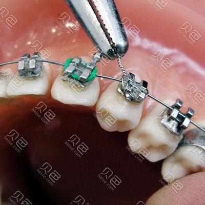 正畸结扎丝弯制视频-图1