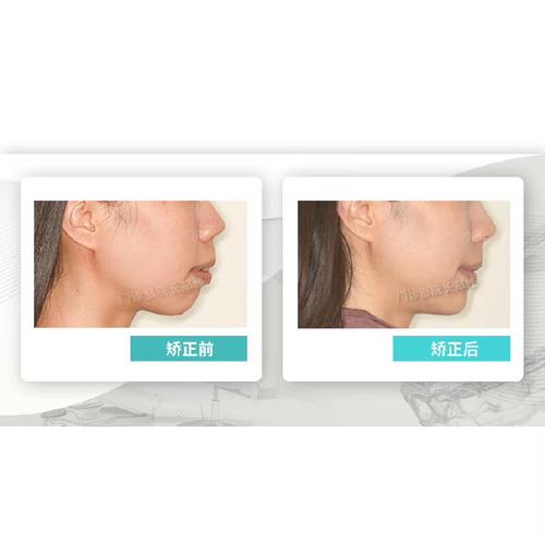 正畸逆时针旋转下巴-图3 正畸逆时针旋转下巴-图3