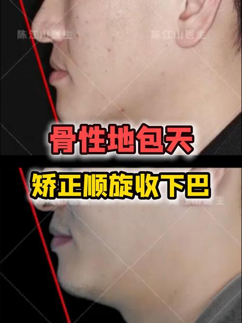 正畸逆时针旋转下巴-图2 正畸逆时针旋转下巴-图2