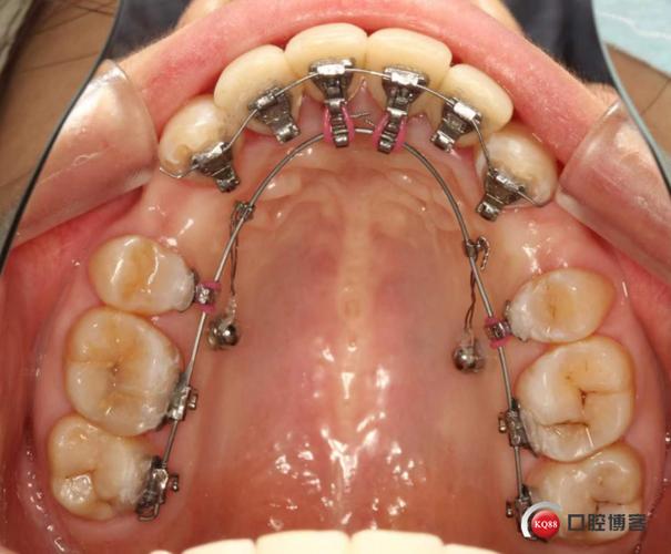 正畸中如何有效防止前牙舌倾？-图2