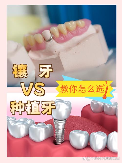 种牙与镶牙区别-图2 种牙与镶牙区别-图2