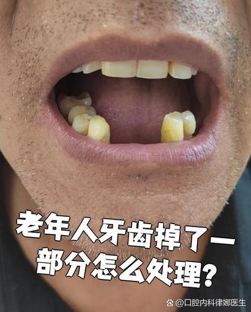 牙掉了能种牙吗-图1
