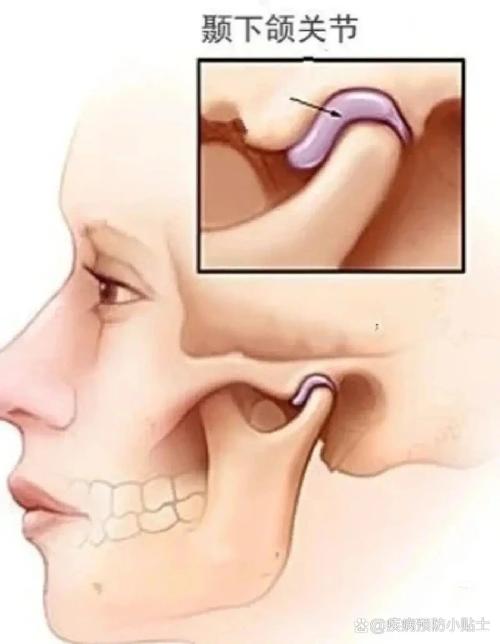 正畸过程中下巴为何脱位？原因、处理及预防建议-图1