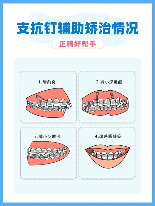 正畸支抗钉 好必特-图3