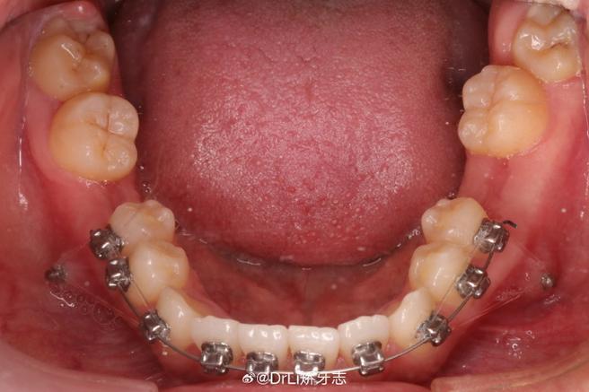 正畸剩20颗牙齿了-图1