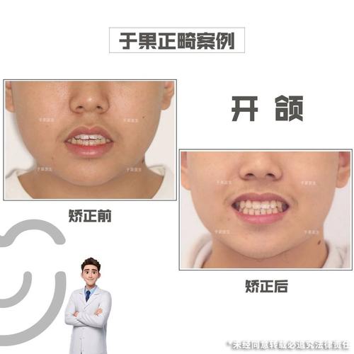 开颌正畸后容易复发吗？如何有效降低复发风险？-图1