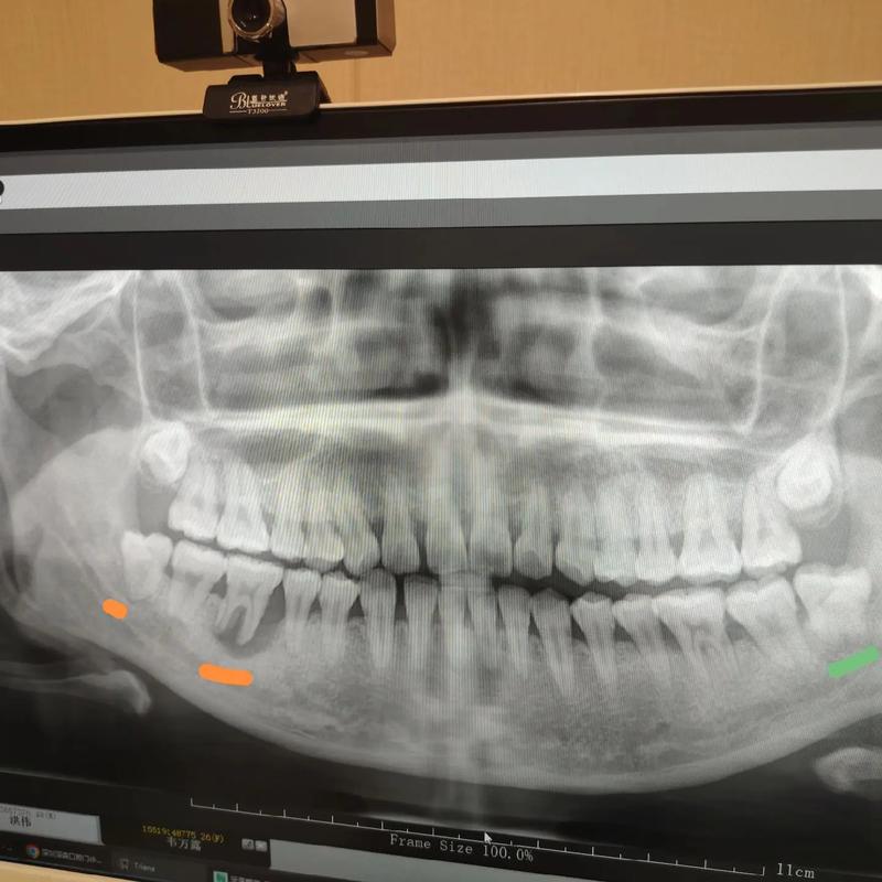 正畸上智齿近中漂移-图3