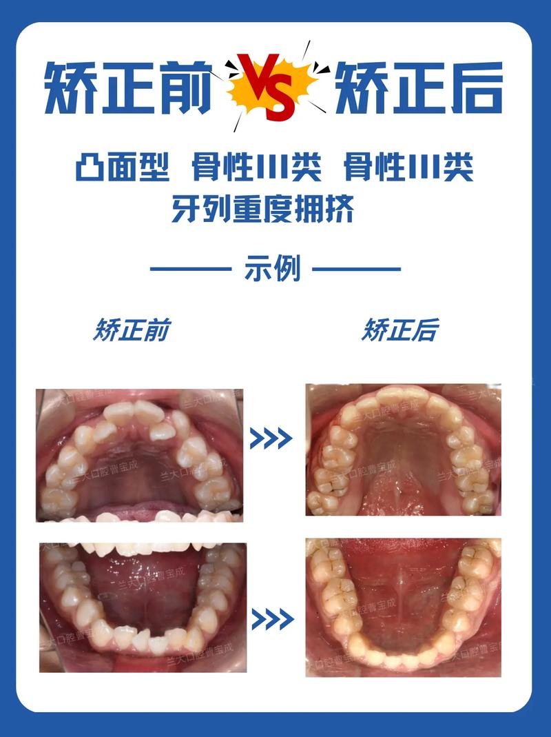正畸牙齿拥挤的分类方法有哪些？-图1
