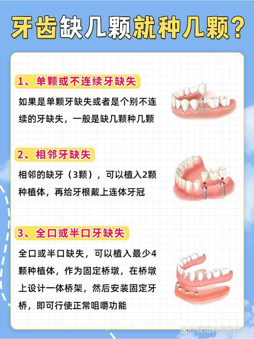 种一颗牙要多久-图1 种一颗牙要多久-图1