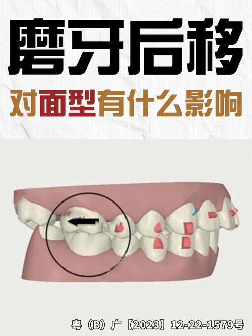 正畸后牙前移的方法-图3