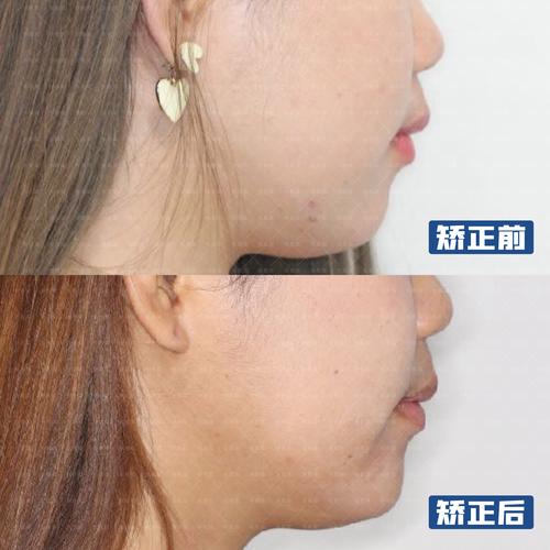 正畸期间后牙齿开合-图1