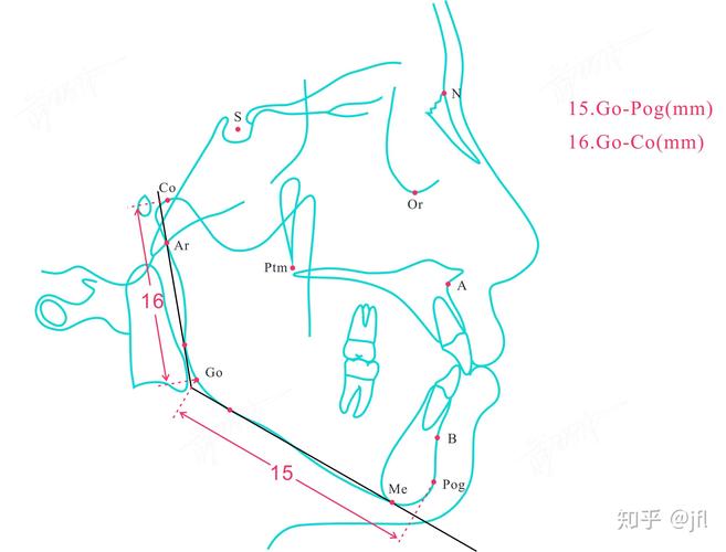 正畸u1 sn夹角-图3