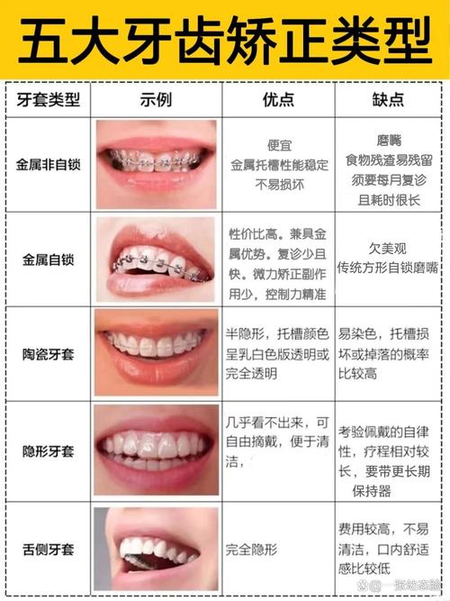 牙套有哪一种-图1
