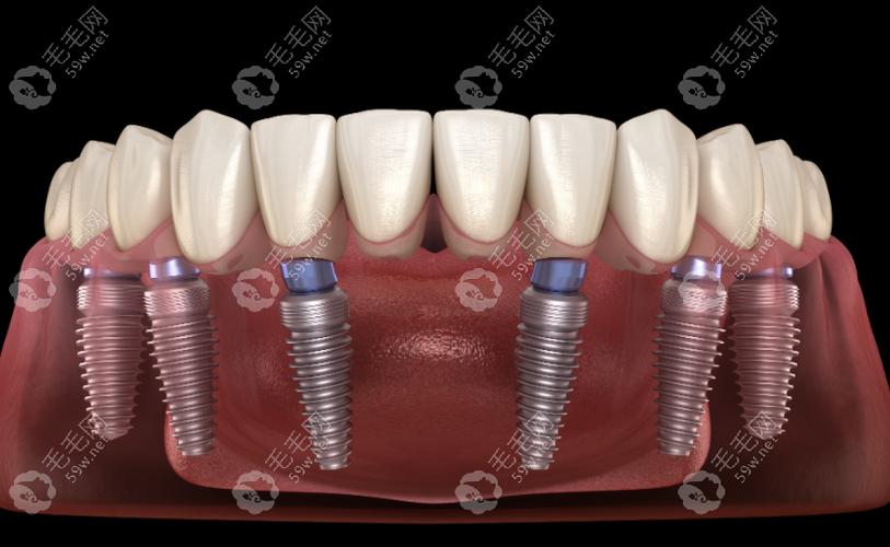 on6种植牙-图1 on6种植牙-图1