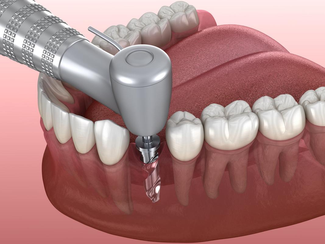 种牙一点不疼-图3