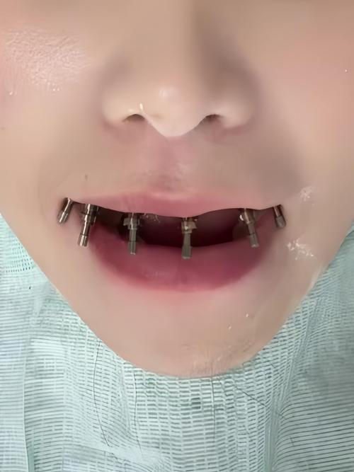 种两颗半口牙-图1 种两颗半口牙-图1