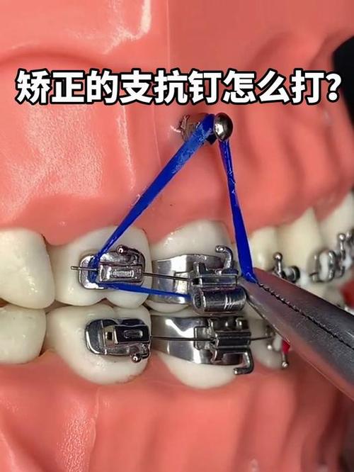 正畸支抗钉取钉疼吗?具体步骤和注意事项有哪些?-图2 正畸支抗钉取钉疼吗?具体步骤和注意事项有哪些?-图2