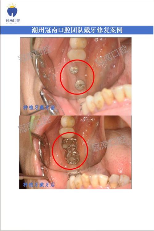 种牙一根两冠-图2